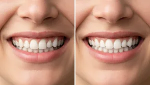 découvrez des transformations spectaculaires avant et après la pose d'un appareil dentaire. retrouvez des sourires rénovés grâce à nos exemples impressionnants.